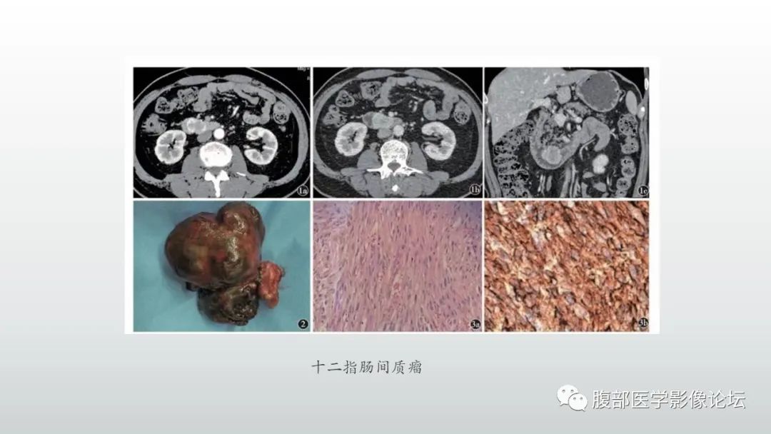 影像PPT - 【PPT】异位胰腺影像诊断-23