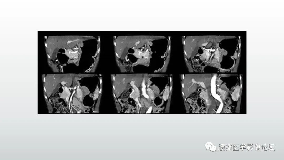 影像PPT - 【PPT】异位胰腺影像诊断-32