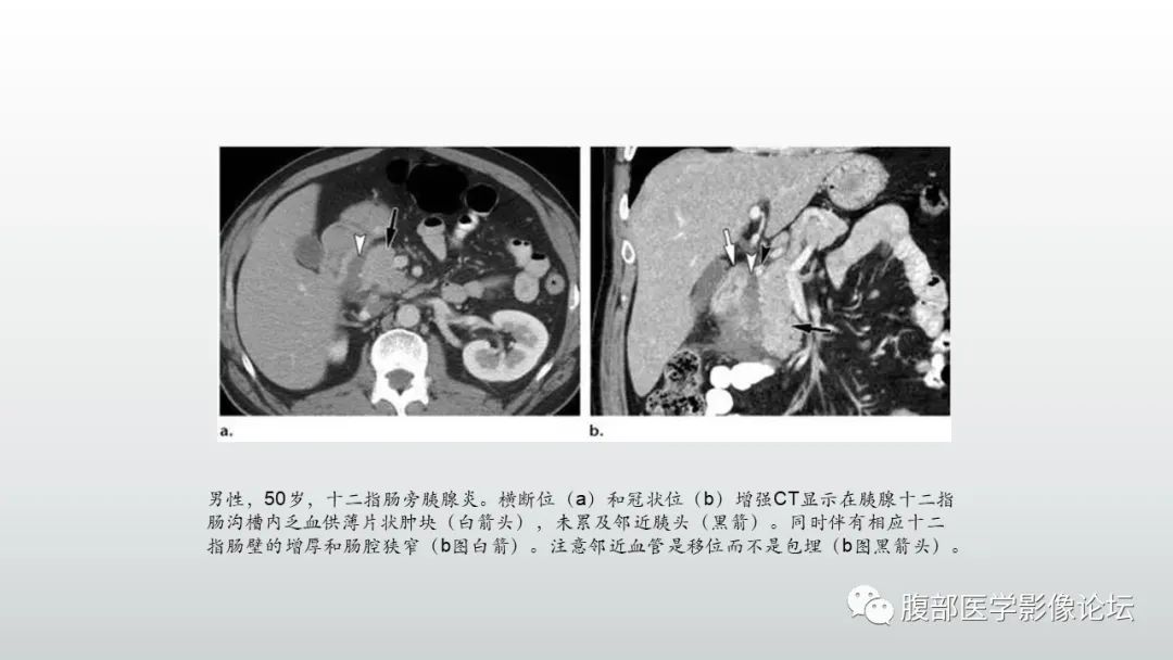 影像PPT - 【PPT】异位胰腺影像诊断-37