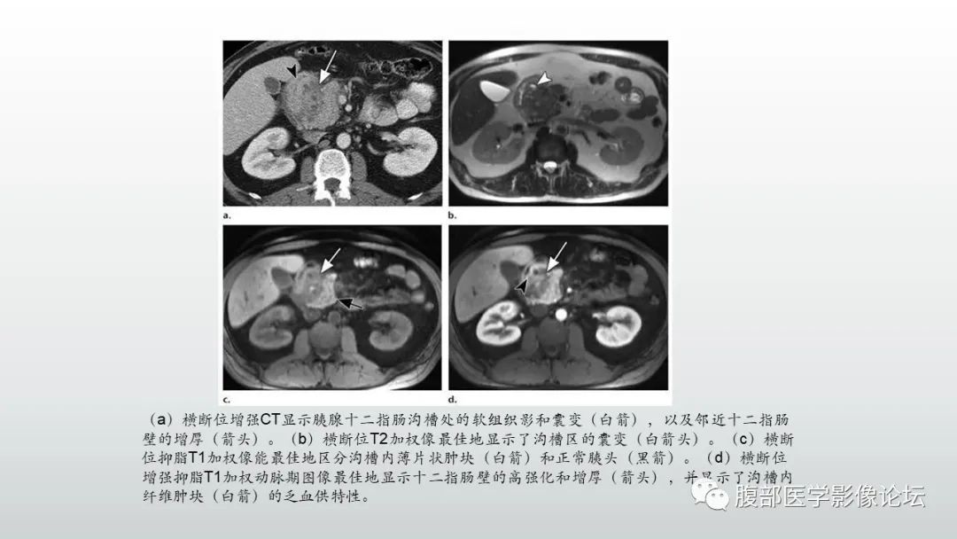 影像PPT - 【PPT】异位胰腺影像诊断-38