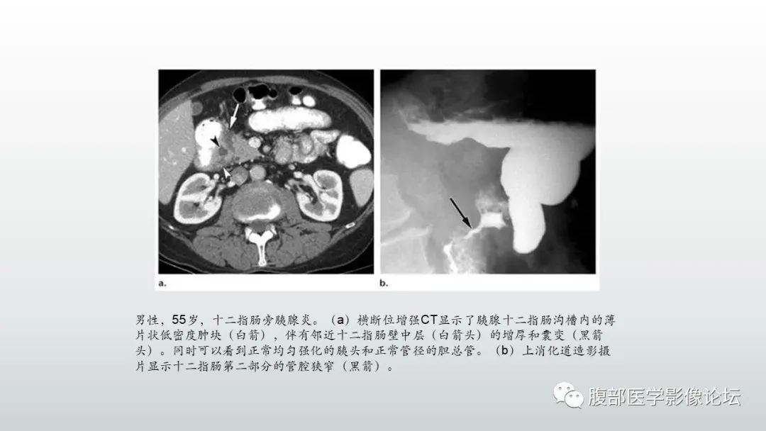 影像PPT - 【PPT】异位胰腺影像诊断-39