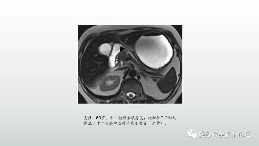 影像PPT - 【PPT】异位胰腺影像诊断-40