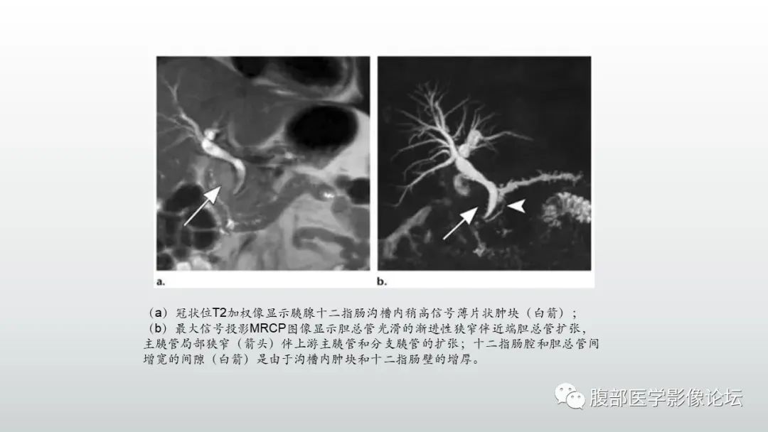 影像PPT - 【PPT】异位胰腺影像诊断-41