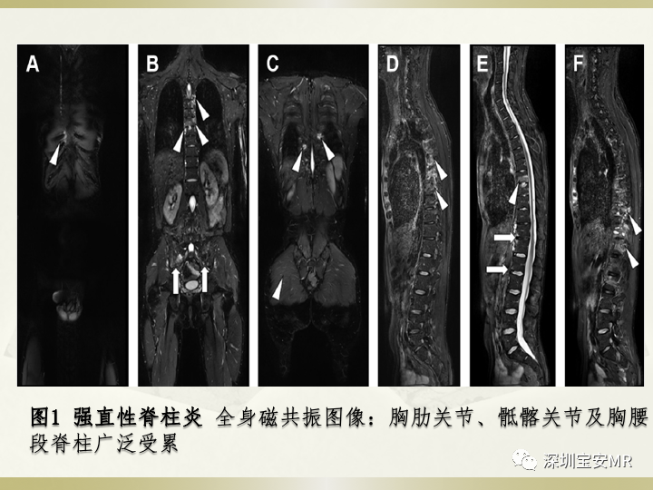 影像PPT - 【PPT】风湿性、系统性疾病全身磁共振成像-5