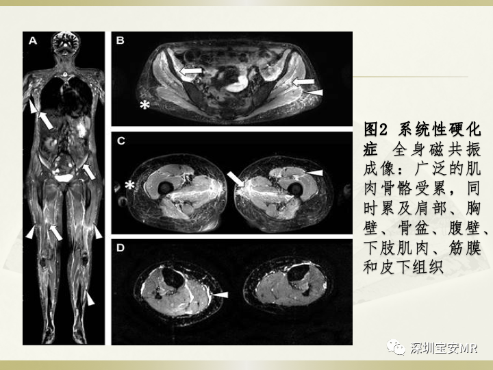 影像PPT - 【PPT】风湿性、系统性疾病全身磁共振成像-7