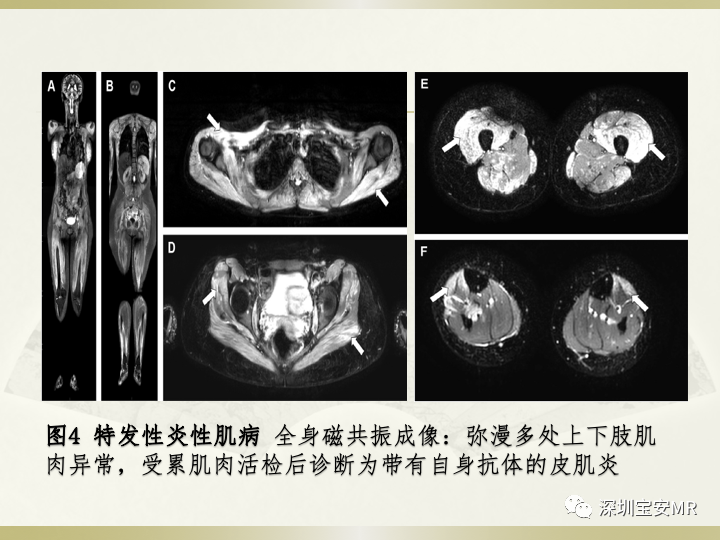 影像PPT - 【PPT】风湿性、系统性疾病全身磁共振成像-11