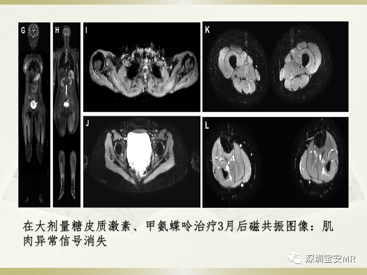 影像PPT - 【PPT】风湿性、系统性疾病全身磁共振成像-12