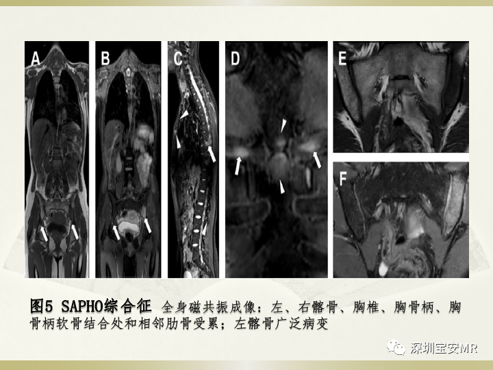 影像PPT - 【PPT】风湿性、系统性疾病全身磁共振成像-14
