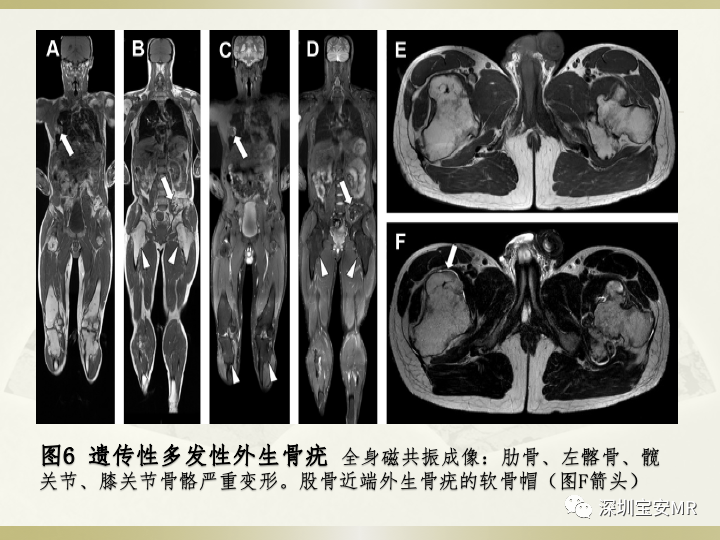 影像PPT - 【PPT】风湿性、系统性疾病全身磁共振成像-16