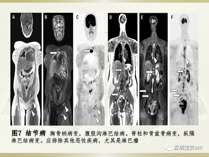 影像PPT - 【PPT】风湿性、系统性疾病全身磁共振成像-18