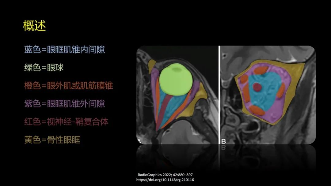 影像PPT - 【PPT】儿童眼眶肿瘤和肿瘤样病变的影像诊断-4 影像PPT - 【PPT】儿童眼眶肿瘤和肿瘤样病变的影像诊断-4