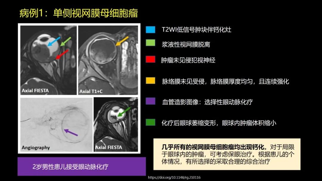 影像PPT - 【PPT】儿童眼眶肿瘤和肿瘤样病变的影像诊断-11 影像PPT - 【PPT】儿童眼眶肿瘤和肿瘤样病变的影像诊断-11