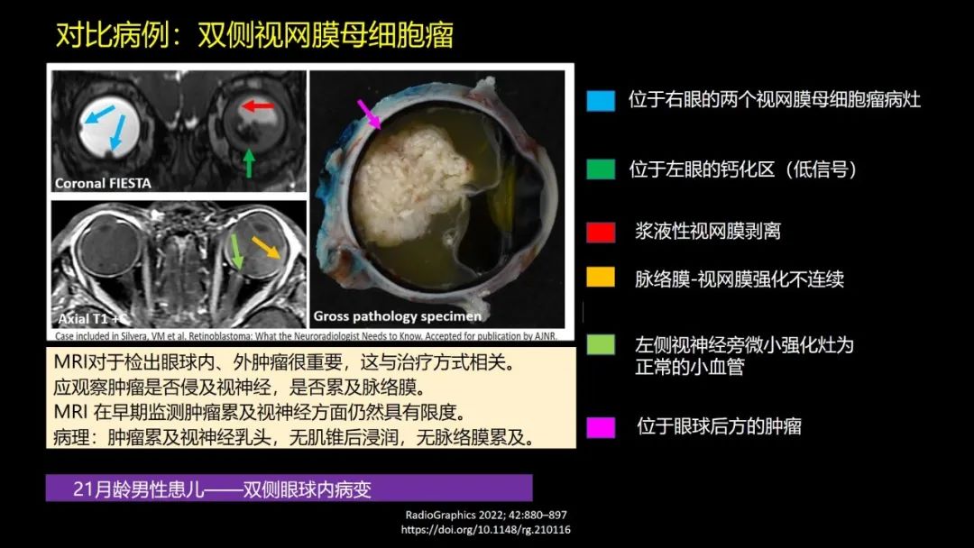 影像PPT - 【PPT】儿童眼眶肿瘤和肿瘤样病变的影像诊断-13 影像PPT - 【PPT】儿童眼眶肿瘤和肿瘤样病变的影像诊断-13