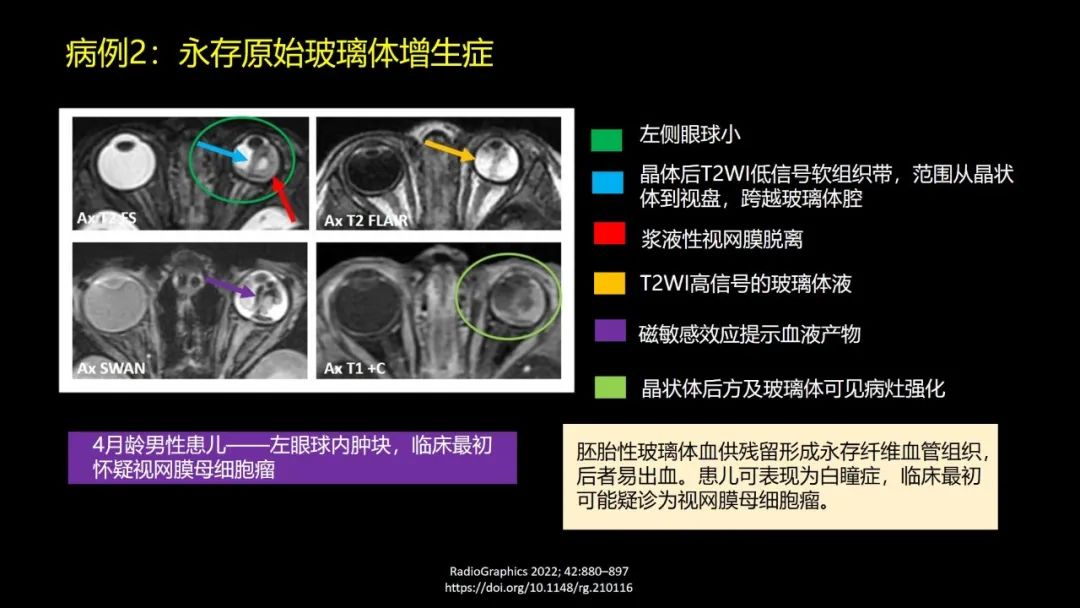 影像PPT - 【PPT】儿童眼眶肿瘤和肿瘤样病变的影像诊断-15 影像PPT - 【PPT】儿童眼眶肿瘤和肿瘤样病变的影像诊断-15