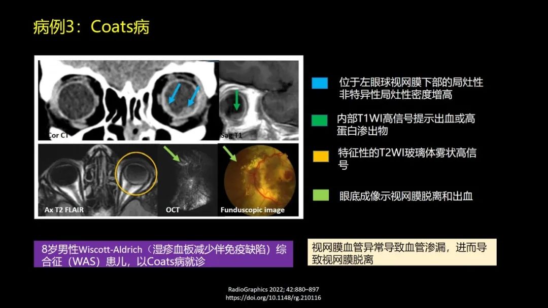 影像PPT - 【PPT】儿童眼眶肿瘤和肿瘤样病变的影像诊断-17 影像PPT - 【PPT】儿童眼眶肿瘤和肿瘤样病变的影像诊断-17