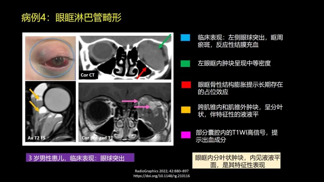 影像PPT - 【PPT】儿童眼眶肿瘤和肿瘤样病变的影像诊断-20 影像PPT - 【PPT】儿童眼眶肿瘤和肿瘤样病变的影像诊断-20