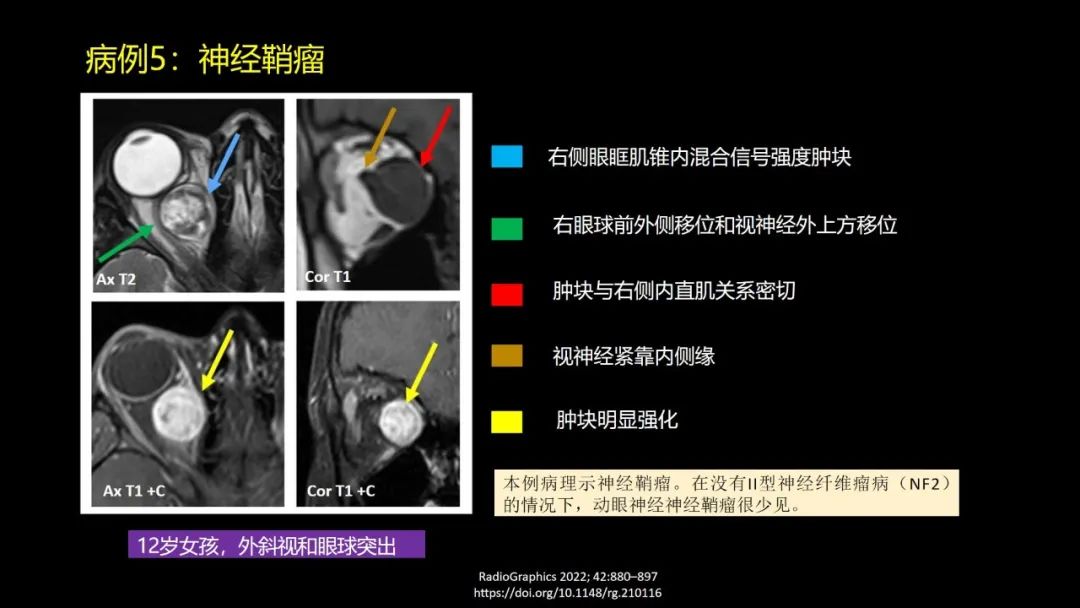 影像PPT - 【PPT】儿童眼眶肿瘤和肿瘤样病变的影像诊断-22 影像PPT - 【PPT】儿童眼眶肿瘤和肿瘤样病变的影像诊断-22