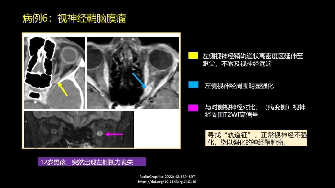 影像PPT - 【PPT】儿童眼眶肿瘤和肿瘤样病变的影像诊断-24 影像PPT - 【PPT】儿童眼眶肿瘤和肿瘤样病变的影像诊断-24