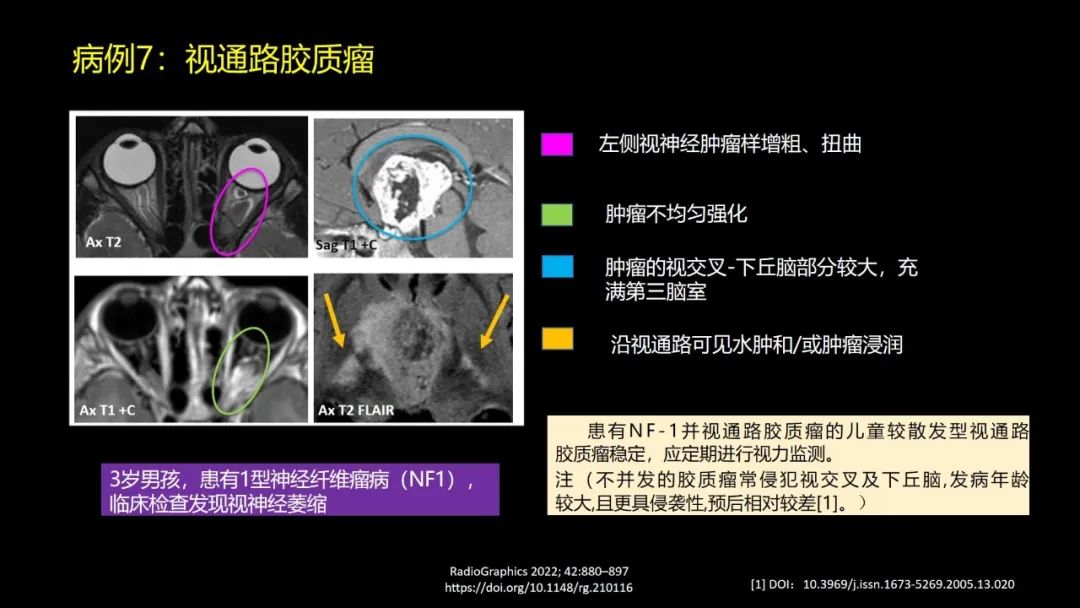 影像PPT - 【PPT】儿童眼眶肿瘤和肿瘤样病变的影像诊断-26 影像PPT - 【PPT】儿童眼眶肿瘤和肿瘤样病变的影像诊断-26