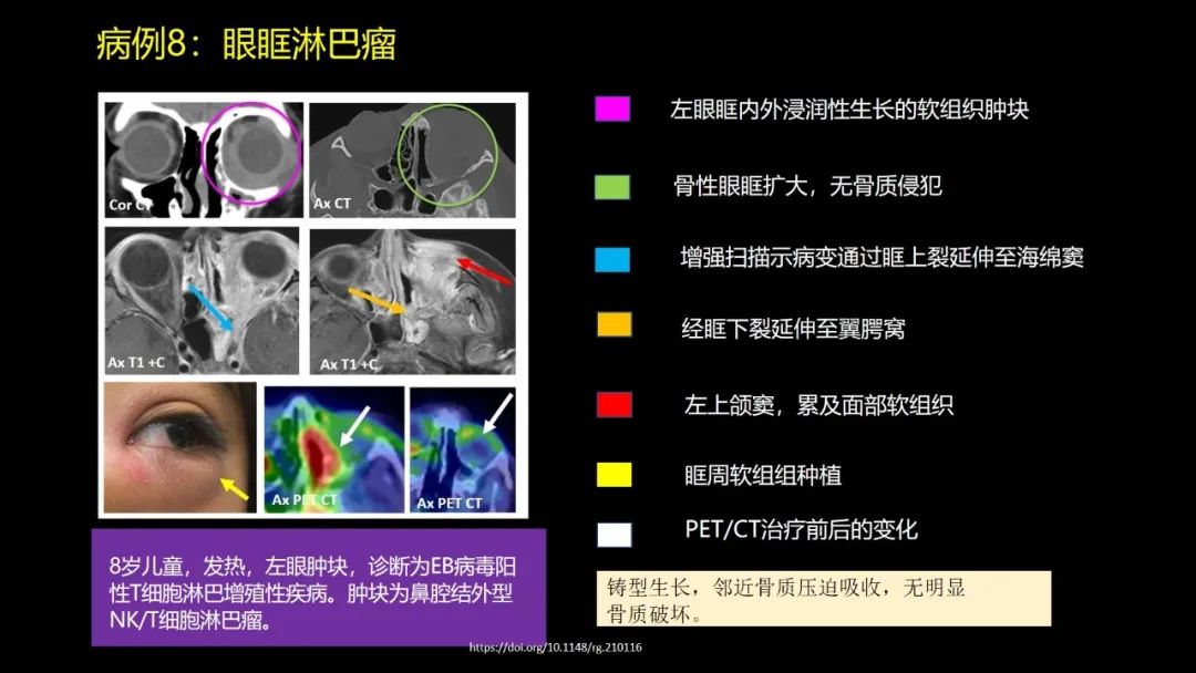 影像PPT - 【PPT】儿童眼眶肿瘤和肿瘤样病变的影像诊断-28 影像PPT - 【PPT】儿童眼眶肿瘤和肿瘤样病变的影像诊断-28
