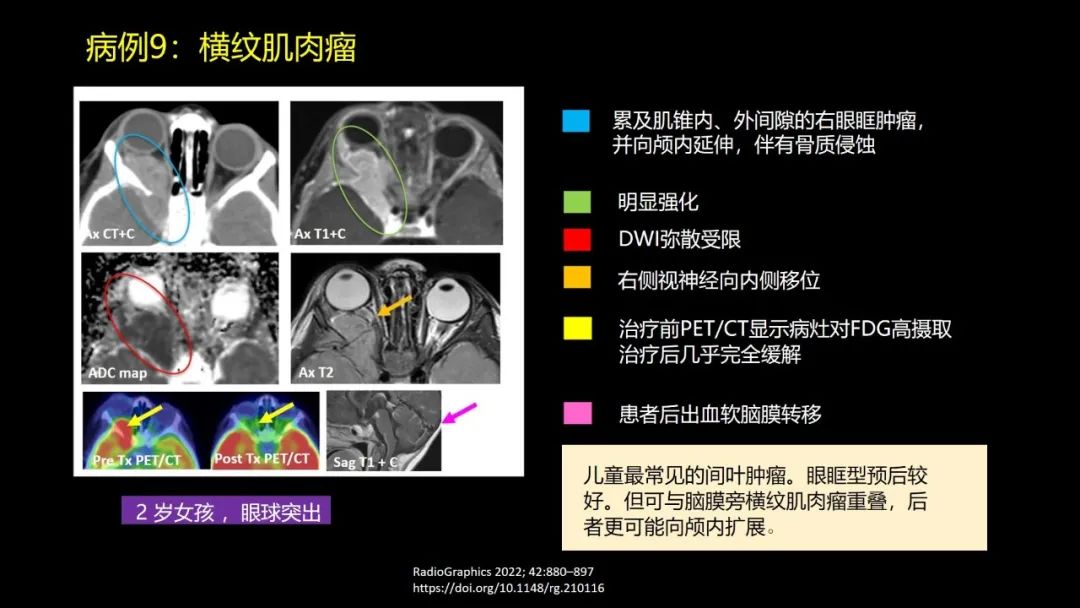 影像PPT - 【PPT】儿童眼眶肿瘤和肿瘤样病变的影像诊断-30 影像PPT - 【PPT】儿童眼眶肿瘤和肿瘤样病变的影像诊断-30