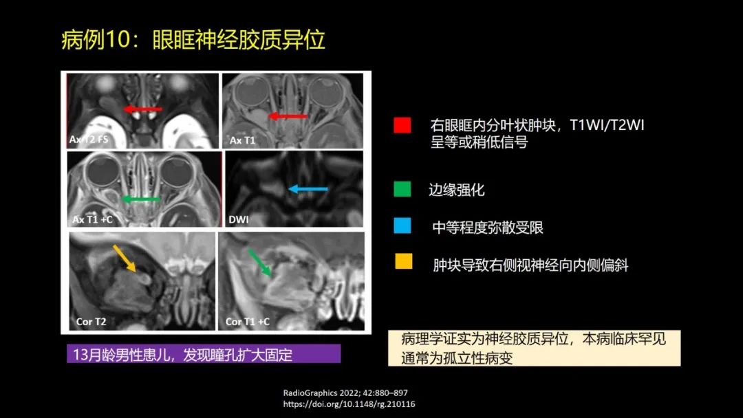 影像PPT - 【PPT】儿童眼眶肿瘤和肿瘤样病变的影像诊断-32 影像PPT - 【PPT】儿童眼眶肿瘤和肿瘤样病变的影像诊断-32