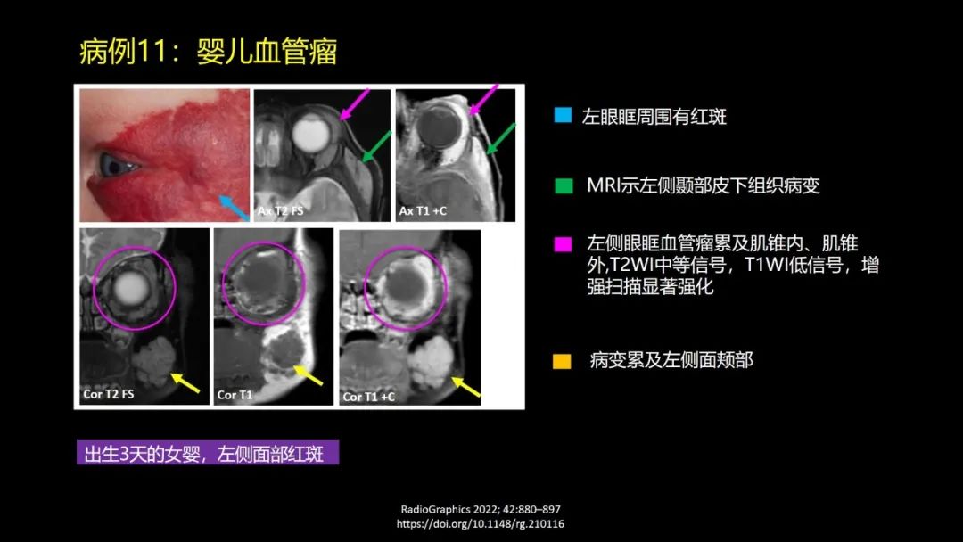 影像PPT - 【PPT】儿童眼眶肿瘤和肿瘤样病变的影像诊断-35 影像PPT - 【PPT】儿童眼眶肿瘤和肿瘤样病变的影像诊断-35