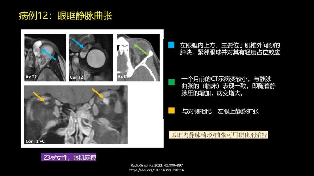 影像PPT - 【PPT】儿童眼眶肿瘤和肿瘤样病变的影像诊断-37 影像PPT - 【PPT】儿童眼眶肿瘤和肿瘤样病变的影像诊断-37