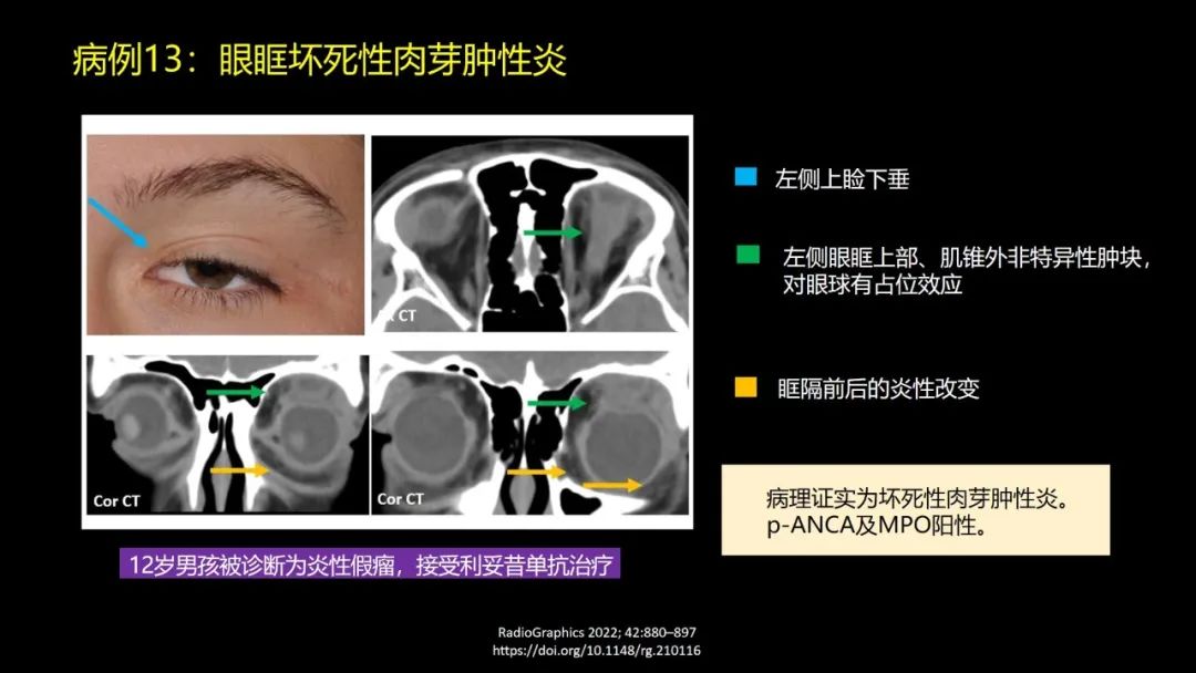 影像PPT - 【PPT】儿童眼眶肿瘤和肿瘤样病变的影像诊断-39 影像PPT - 【PPT】儿童眼眶肿瘤和肿瘤样病变的影像诊断-39