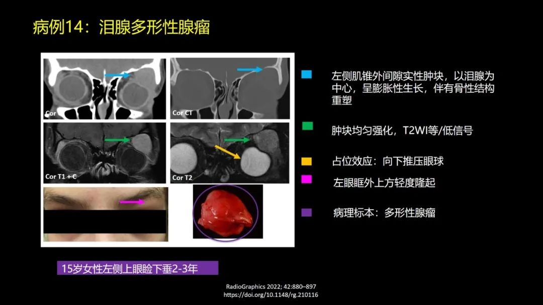 影像PPT - 【PPT】儿童眼眶肿瘤和肿瘤样病变的影像诊断-41 影像PPT - 【PPT】儿童眼眶肿瘤和肿瘤样病变的影像诊断-41