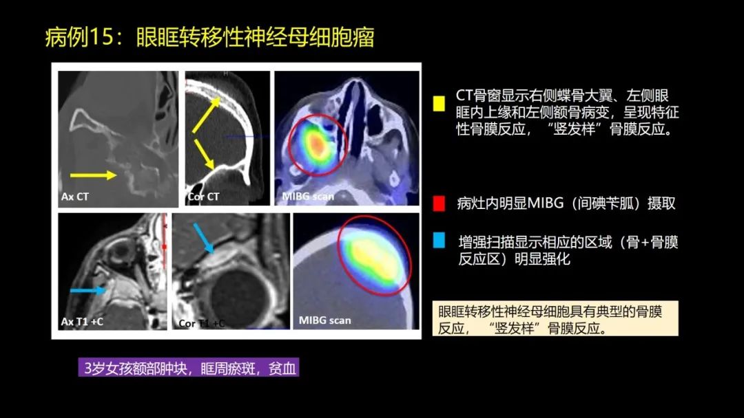 影像PPT - 【PPT】儿童眼眶肿瘤和肿瘤样病变的影像诊断-44 影像PPT - 【PPT】儿童眼眶肿瘤和肿瘤样病变的影像诊断-44