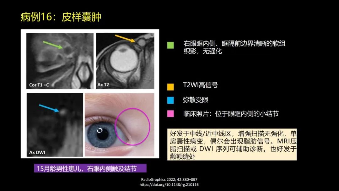 影像PPT - 【PPT】儿童眼眶肿瘤和肿瘤样病变的影像诊断-46 影像PPT - 【PPT】儿童眼眶肿瘤和肿瘤样病变的影像诊断-46