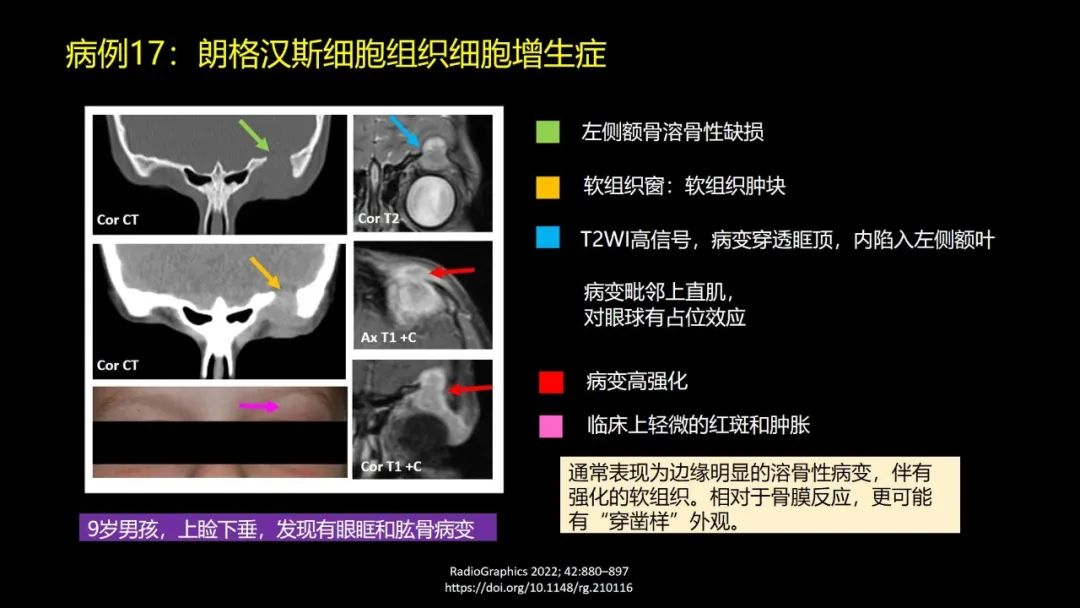 影像PPT - 【PPT】儿童眼眶肿瘤和肿瘤样病变的影像诊断-48 影像PPT - 【PPT】儿童眼眶肿瘤和肿瘤样病变的影像诊断-48