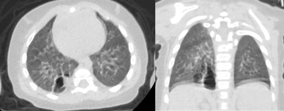 影像PPT - 先天性肺囊性腺瘤样畸形 CCAM-2 影像PPT - 先天性肺囊性腺瘤样畸形 CCAM-2