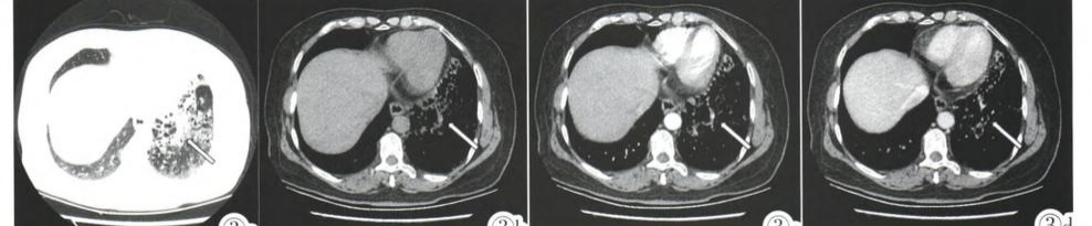 影像PPT - 先天性肺囊性腺瘤样畸形 CCAM-5 影像PPT - 先天性肺囊性腺瘤样畸形 CCAM-5