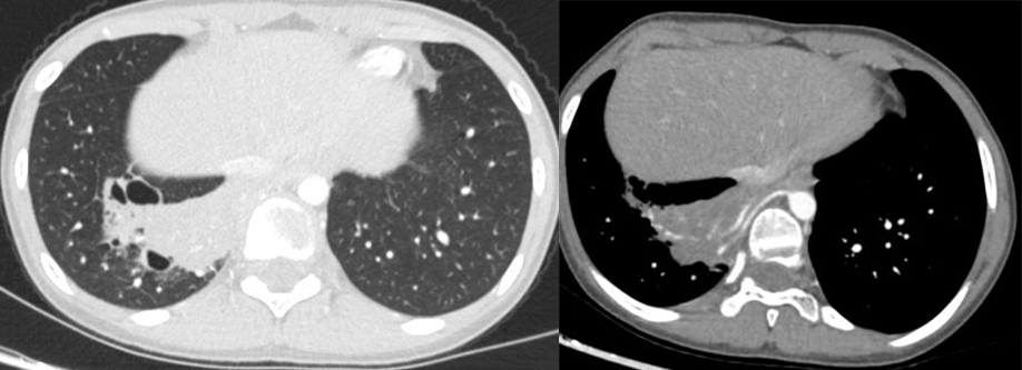 影像PPT - 先天性肺囊性腺瘤样畸形 CCAM-6 影像PPT - 先天性肺囊性腺瘤样畸形 CCAM-6