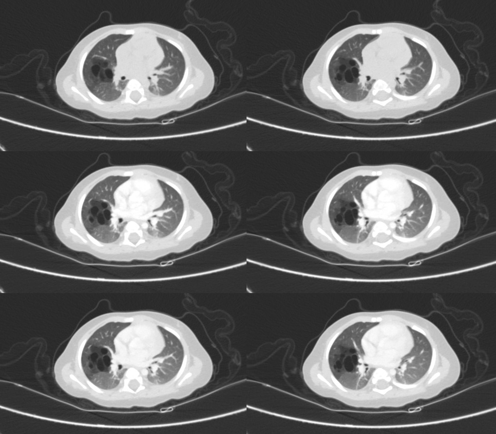 影像PPT - 先天性肺囊性腺瘤样畸形 CCAM-1 影像PPT - 先天性肺囊性腺瘤样畸形 CCAM-1