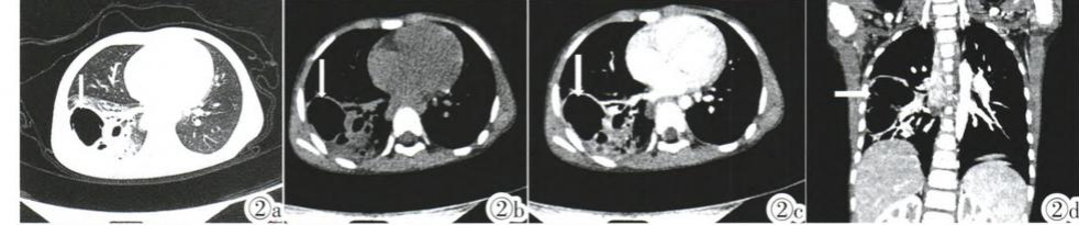 影像PPT - 先天性肺囊性腺瘤样畸形 CCAM-4 影像PPT - 先天性肺囊性腺瘤样畸形 CCAM-4