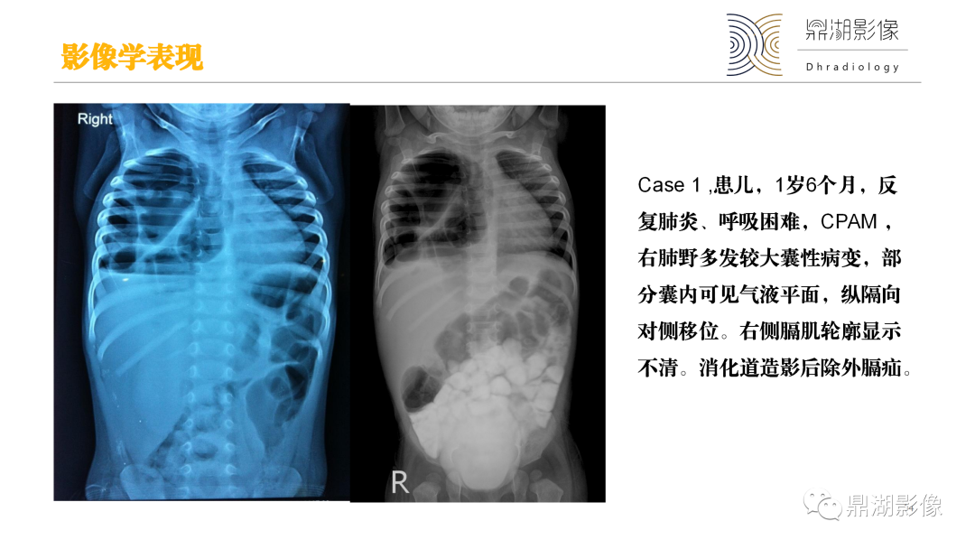 影像PPT - 【PPT】先天性肺囊性腺瘤样畸形-14
