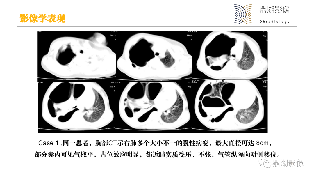 影像PPT - 【PPT】先天性肺囊性腺瘤样畸形-15
