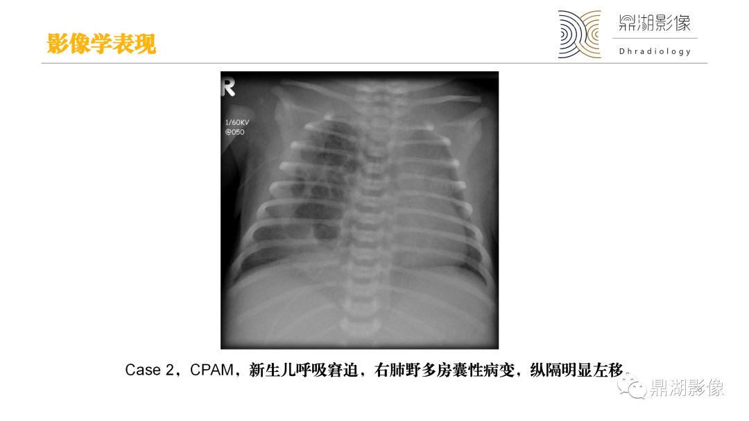 影像PPT - 【PPT】先天性肺囊性腺瘤样畸形-16