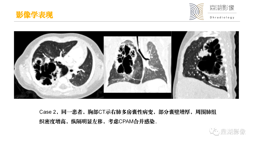 影像PPT - 【PPT】先天性肺囊性腺瘤样畸形-17