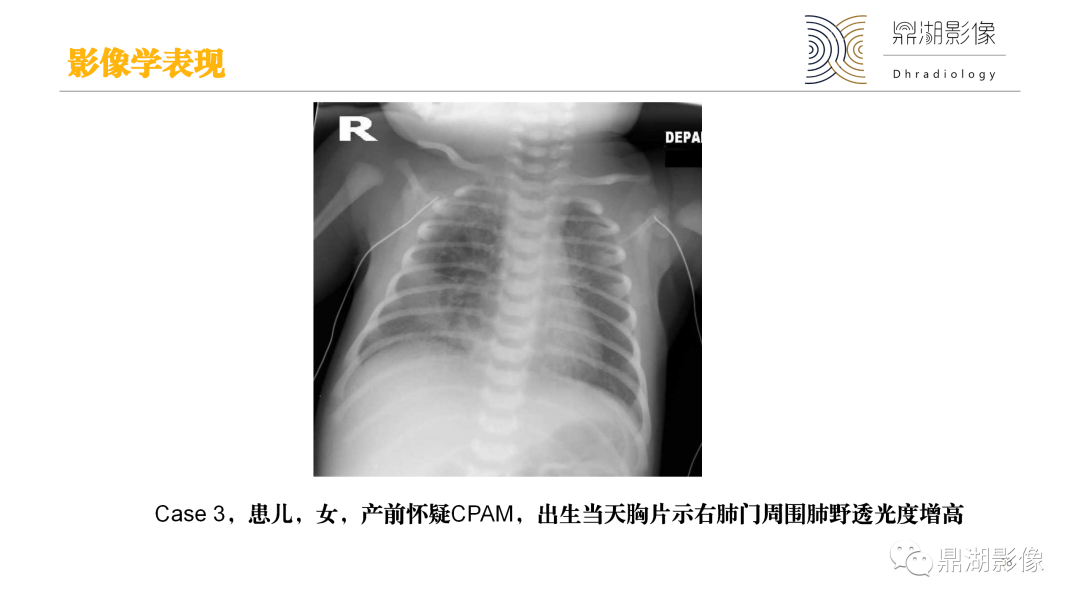 影像PPT - 【PPT】先天性肺囊性腺瘤样畸形-18
