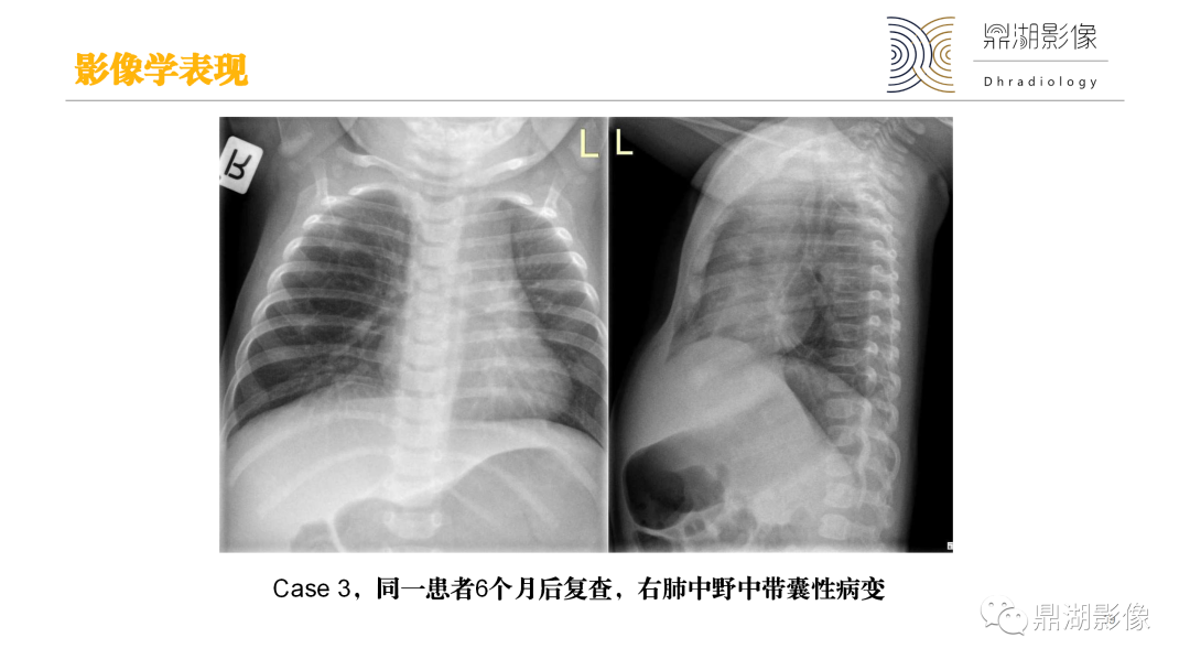 影像PPT - 【PPT】先天性肺囊性腺瘤样畸形-19