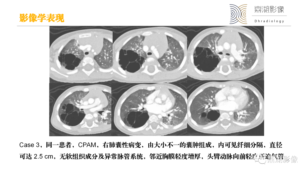 影像PPT - 【PPT】先天性肺囊性腺瘤样畸形-20