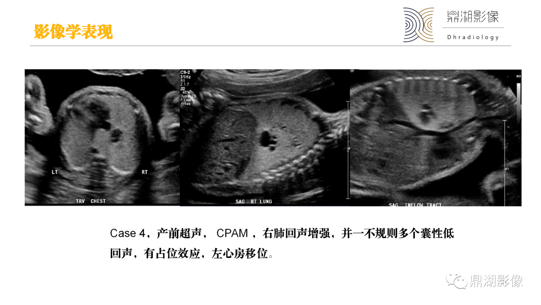 影像PPT - 【PPT】先天性肺囊性腺瘤样畸形-21