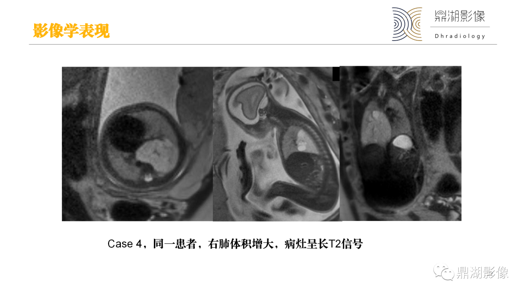 影像PPT - 【PPT】先天性肺囊性腺瘤样畸形-22