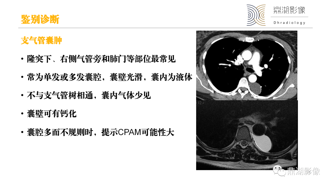 影像PPT - 【PPT】先天性肺囊性腺瘤样畸形-23