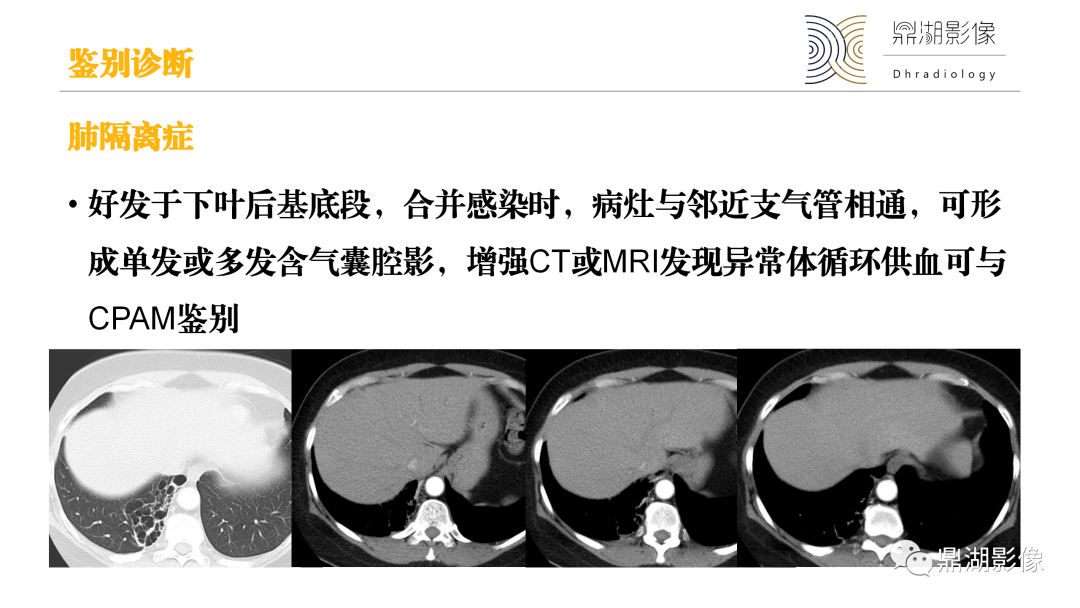 影像PPT - 【PPT】先天性肺囊性腺瘤样畸形-24