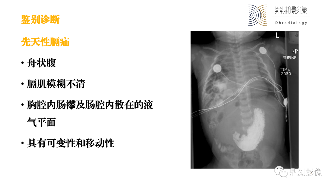 影像PPT - 【PPT】先天性肺囊性腺瘤样畸形-25